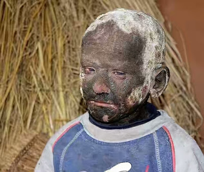 Meet The 11-Year-Old Boy With Skin Condition Slowly Turning Him Into A Stone - PHOTOS! Meet The 11-Year-Old Boy With Skin Condition Slowly Turning Him Into A Stone - PHOTOS!