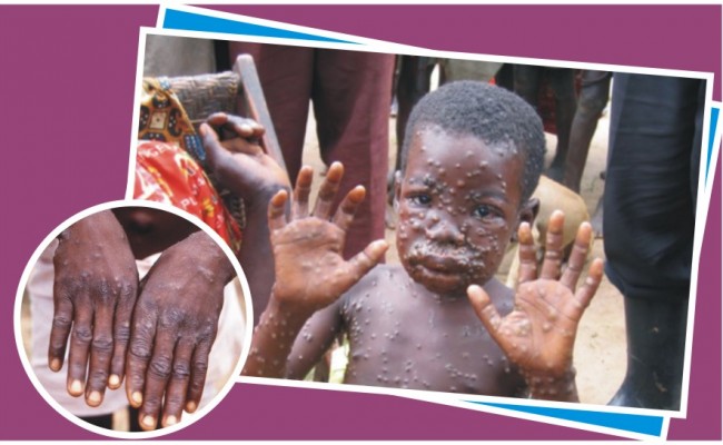 Photo Of A Lady Suffering From Monkey Pox In Enugu