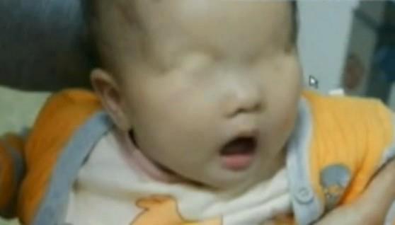Baby born with skin covering the eyes in China