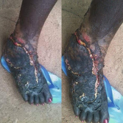 Devil at Work: Man Posts Photos of His Wife's Decaying Leg After She was Attacked by 'Witch Fire' in Benue