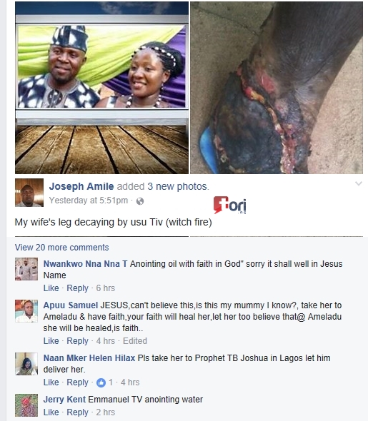 Devil at Work: Man Posts Photos of His Wife's Decaying Leg After She was Attacked by 'Witch Fire' in Benue