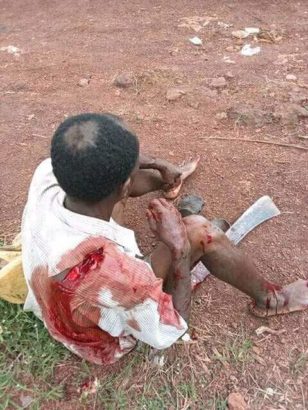 Fulani Herdsmen Allegedly Attack Farmer in Enugu, Chop Off His Fingers (Graphic Photos)