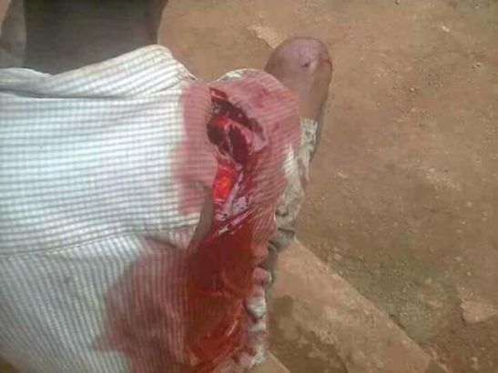 Fulani Herdsmen Allegedly Attack Farmer in Enugu, Chop Off His Fingers (Graphic Photos)