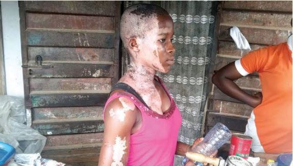Girl Bathed with Acid on Her 14th Birthday in Lagos (Photo)