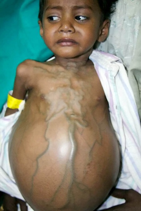 Horror! You Won't Believe What Doctors Removed From This Little Girl's Stomach After Life-Saving Surgery (Photos)
