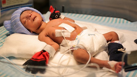 Omg! Baby Boy Born With 4 Legs and Two Male S*x Organs Undergoes Crucial Operation (Photos)