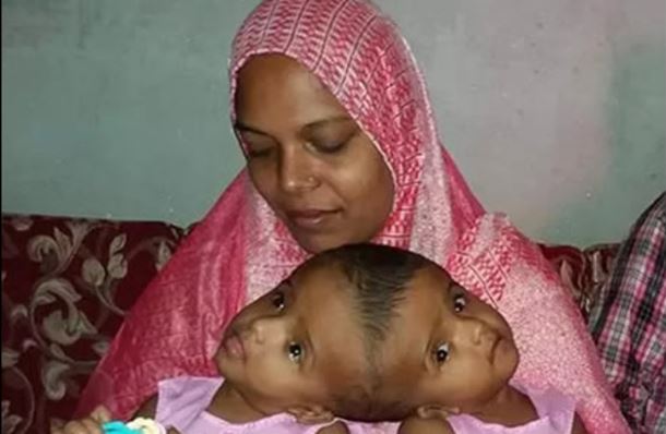 'I Expected A Baby With Big Head, Instead I Got Co-Joined Twins' - Horrified Mother Cries Out