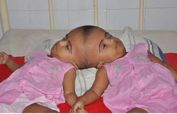 'I Expected A Baby With Big Head, Instead I Got Co-Joined Twins' - Horrified Mother Cries Out