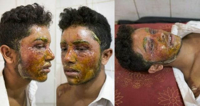 16 year old girl bathes boy with acid because he refused her love proposal.