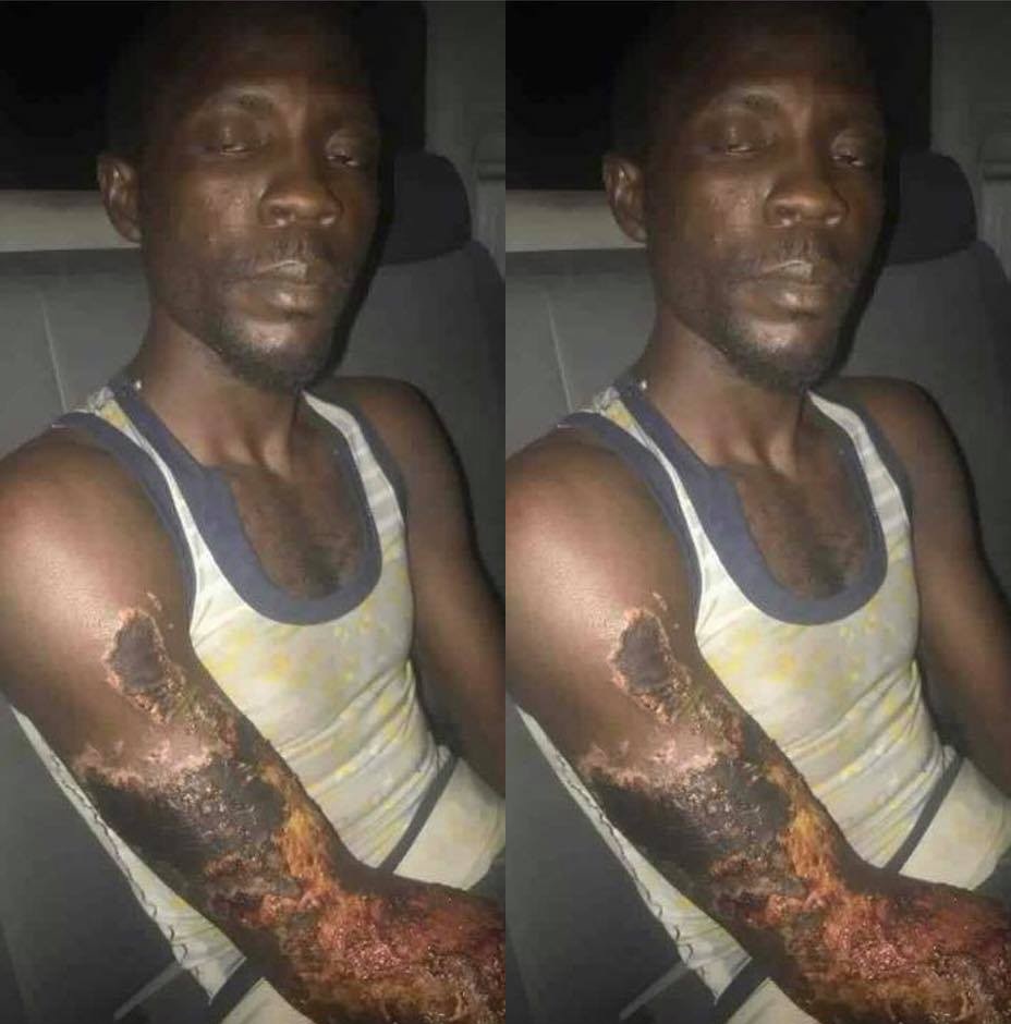 Update: Police arrest boyfriend who bathed UNIMAID Nursing undergraduate with acid because her parents rejected his marriage proposal