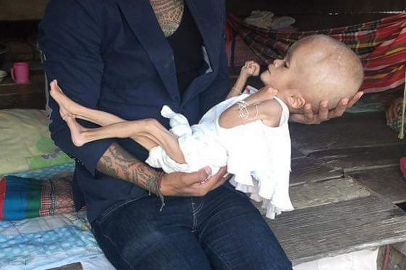 Meet The Baby Girl Born With An Oversized Head Due To Medical Condition (Photos)