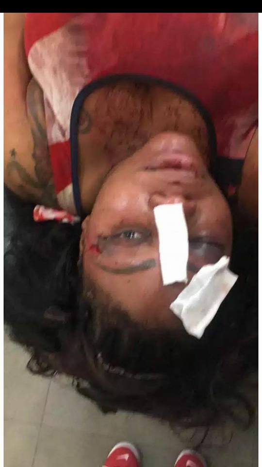 Man Brutalizes His Fiancée Few Weeks After Proposing To Her (Graphic Photos)