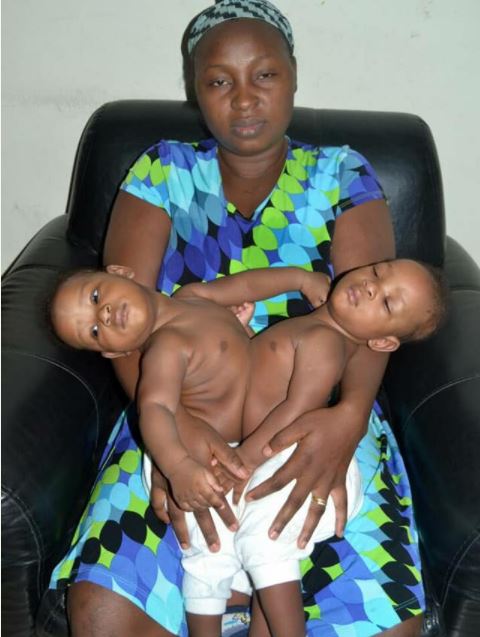 Black Woman Gives Birth To Conjoined Babies (Photos)