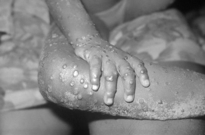 Breaking News: All Schools In Anambra Closed Over Monkeypox Injection