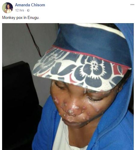 Photo Of A Lady Suffering From Monkey Pox In Enugu