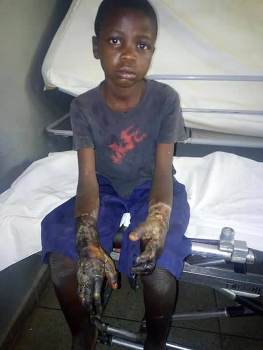 Young Boy Crippled After Being Beaten By His Teacher In Gombe (Graphic Photo)