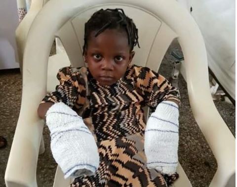 Update On The Little Girl Whose Hands Were Burnt By Her Brutal Grandmother