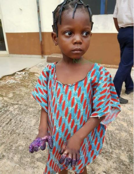 Update On The Little Girl Whose Hands Were Burnt By Her Brutal Grandmother