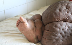 Mom Of Two Has Leg That Weighs 132lbs Due To A Parasitic Condition That Could Kill Her