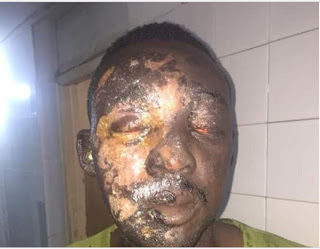 Grenade Scatters Eyes Of Soldier Fighting Boko Haram (Disturbing Photos)