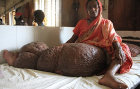 Mom Of Two Has Leg That Weighs 132lbs Due To A Parasitic Condition That Could Kill Her