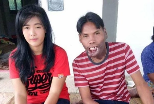 True love? Pretty 21-year-old Lady Marries Poor, Older Man With Facial Deformity (Photos)