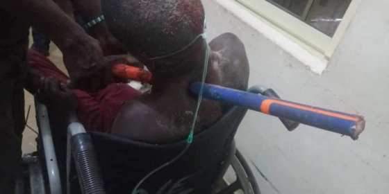Bricklayer who fell from storey building saved by doctors in Imo State