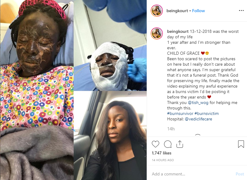 'Been too scared to post the pictures' - Nigerian model marks 1 year of surviving a fire incident
