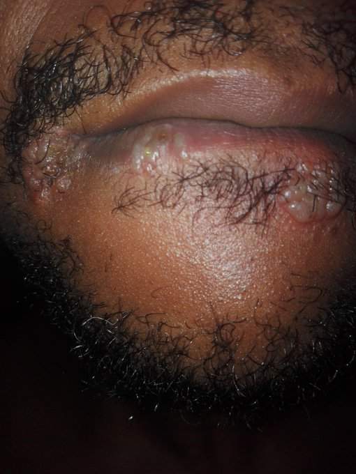 Man reveals what happened to his lips and tongue after oral sex with a girl (Photos)