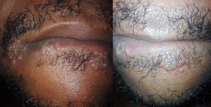Man reveals what happened to his lips and tongue after oral sex with a girl (Photos)