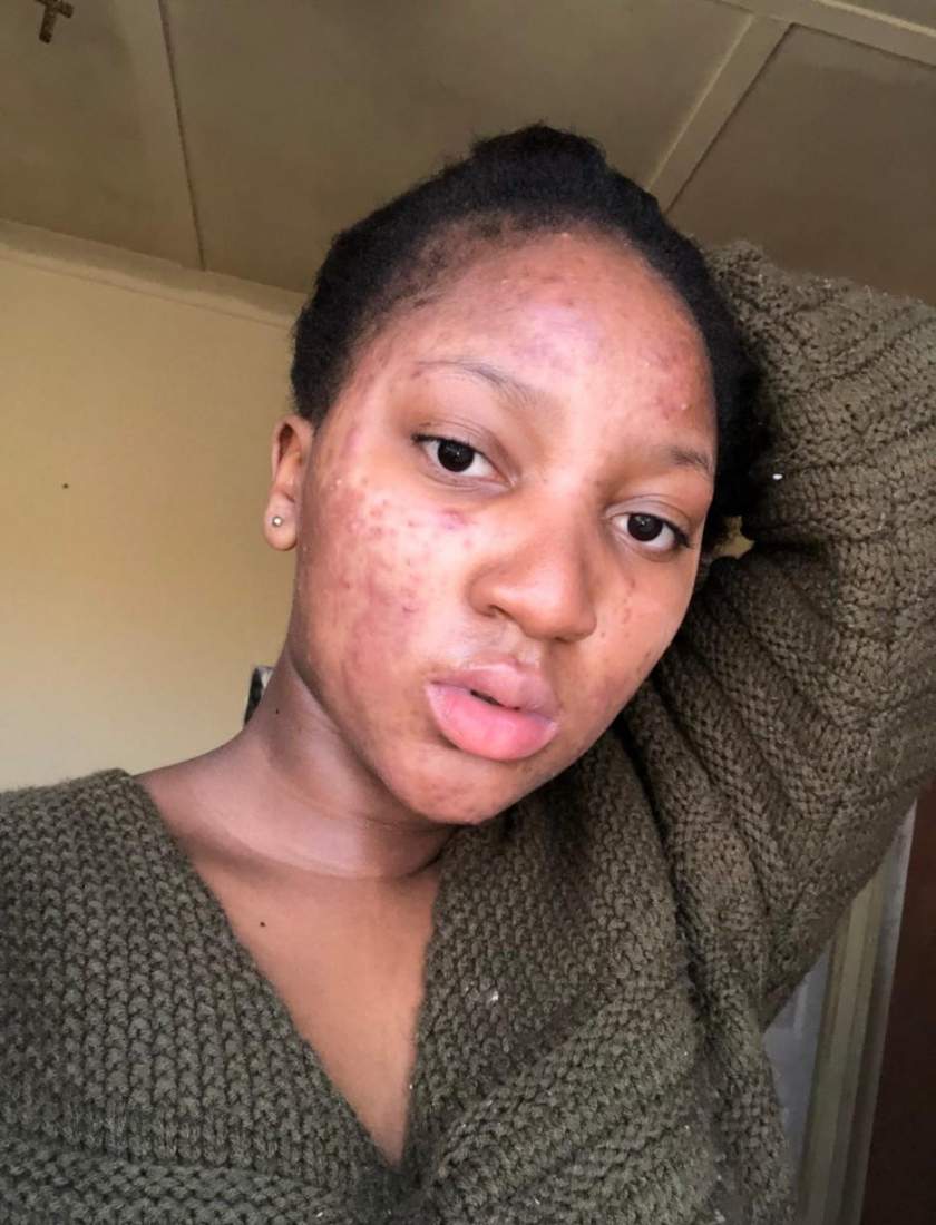 Lady who battled serious acne, shows off her incredible facial transformation (Photos)