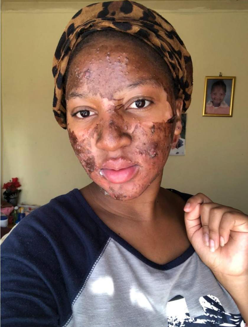 Lady who battled serious acne, shows off her incredible facial transformation (Photos)