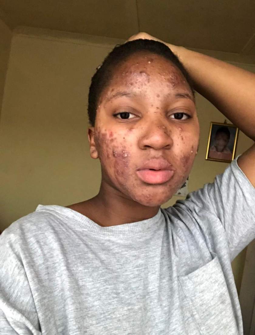 Lady who battled serious acne, shows off her incredible facial transformation (Photos)