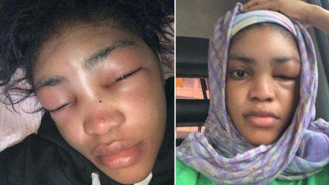 lil frosh girlfriend swollen face beaten