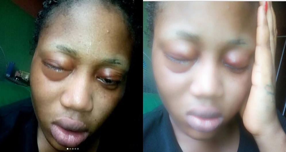 Nigerian Lady Wakes Up From A Nap To Find Her Face Swollen