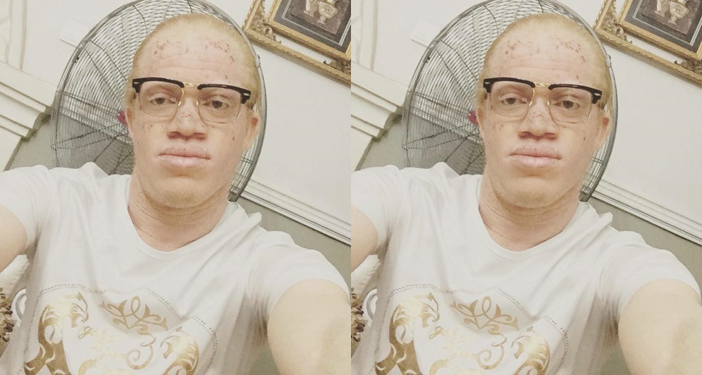 Albino Reveals How His Lady Refused Him From Meeting Her Parents Because Of His Looks