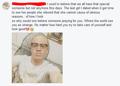 Albino Reveals How His Lady Refused Him From Meeting Her Parents Because Of His Looks