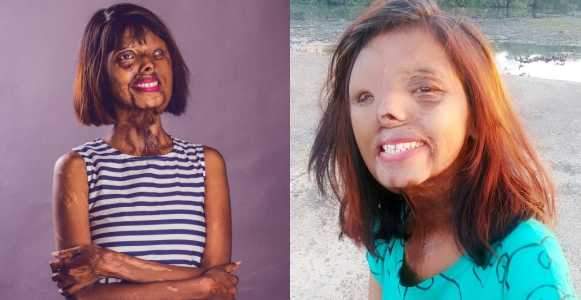 Lady doused in acid by her dad because he wanted a son shares inspiring new year message