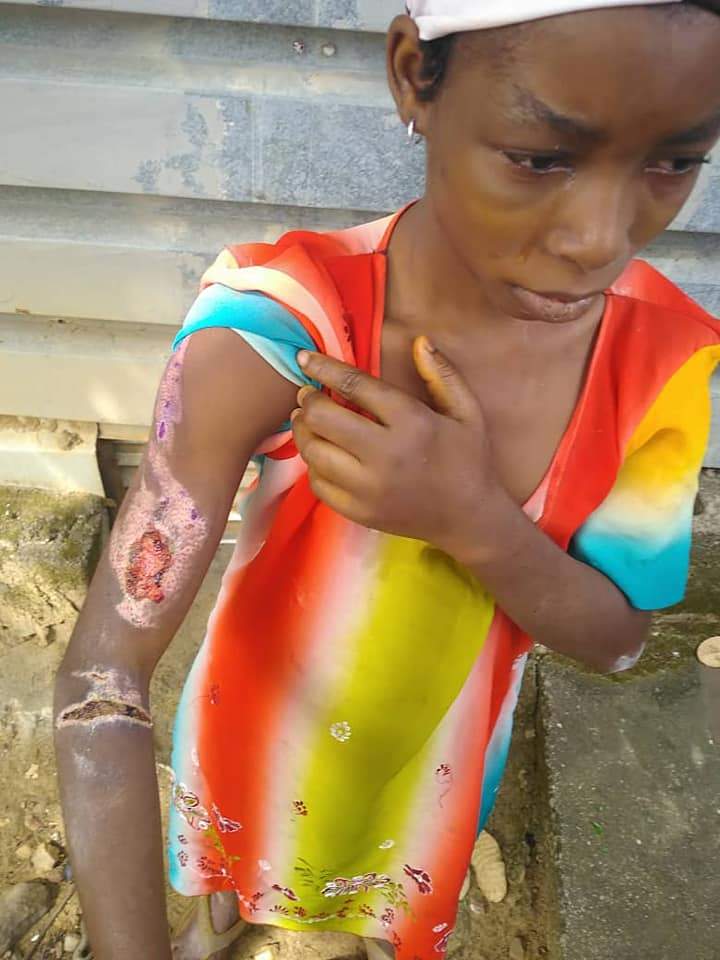 Wicked Heart! Woman Pours Hot Water On Her Niece In Kogi State (Graphic Photos)
