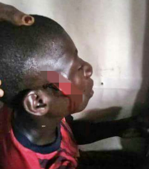 15-year-old Girl Cuts Open A Boy Face During Misunderstanding In Bayelsa (Photos)