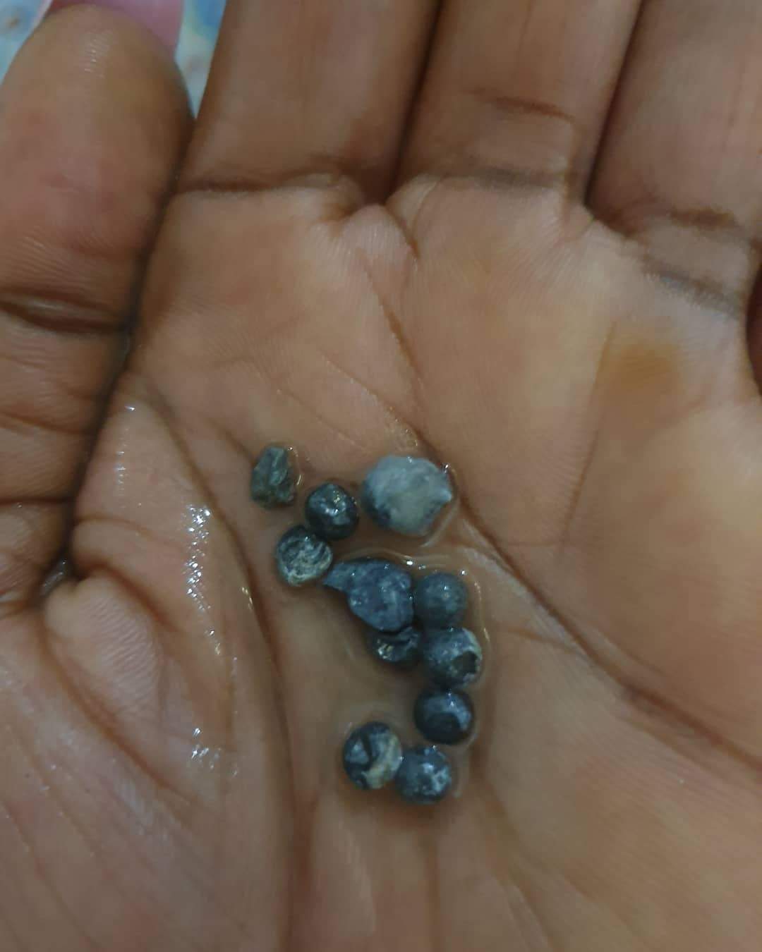 Alleged Assassination Attempt: Angela Okorie shares photo of pellets that were removed her head.