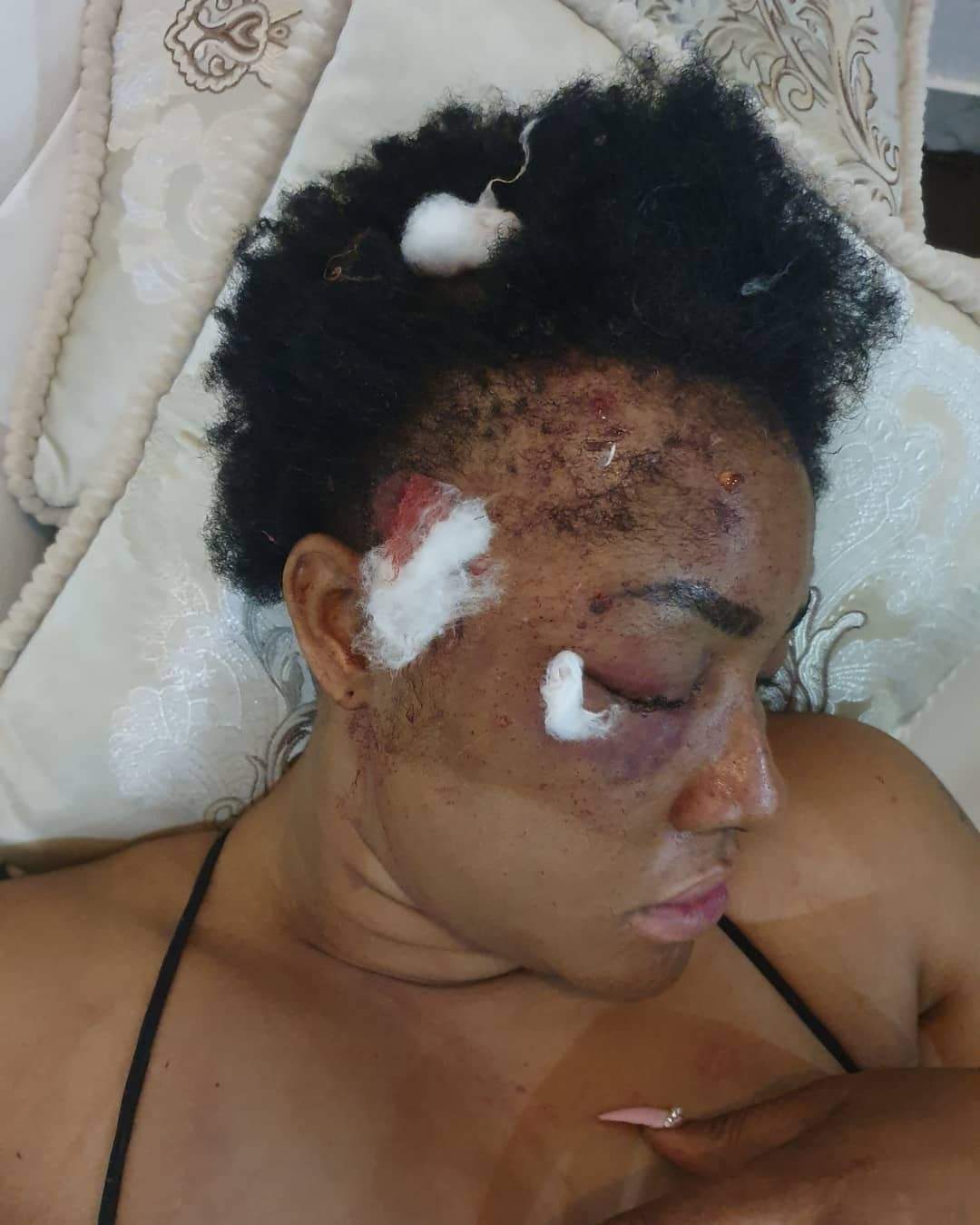 Alleged Assassination Attempt: Angela Okorie shares photo of pellets that were removed her head.