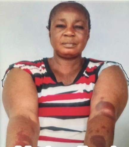Shocking story of a woman who was beaten to a pulp by Landlord for refusing his love advances