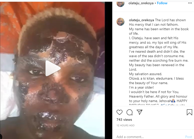 Nigerian lady celebrates her birthday months after surviving gas explosion