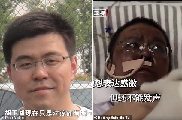 Wuhan doctors who were critically ill with COVID-19 wake up to find that their skin has turned dark after the virus damaged their livers