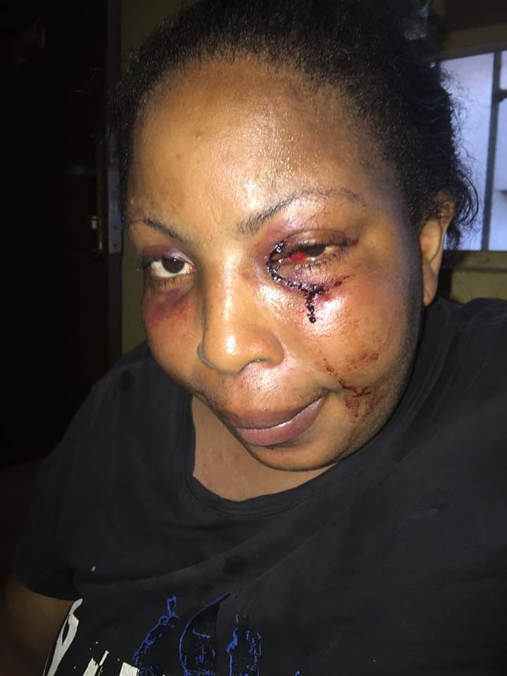 Lady reveals how her drunk husband beat her mercilessly and chased her out of the house in the dead of the night (Photos)
