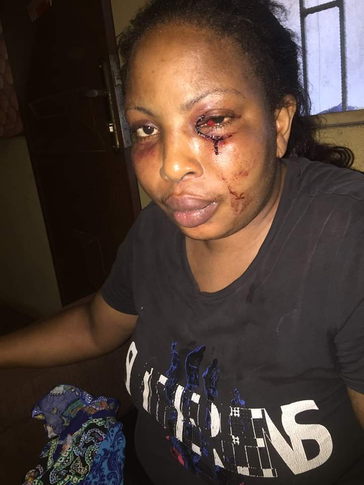 Lady reveals how her drunk husband beat her mercilessly and chased her out of the house in the dead of the night (Photos)