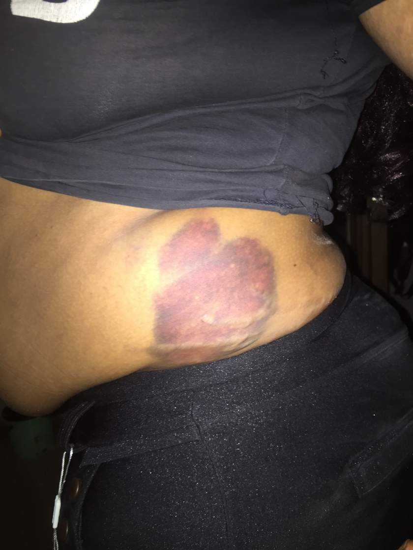 Lady reveals how her drunk husband beat her mercilessly and chased her out of the house in the dead of the night (Photos)