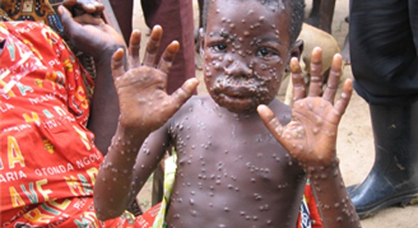 Medical Doctors,10 Others Quarantined in Bayelsa over New Viral Disease, Monkey Pox