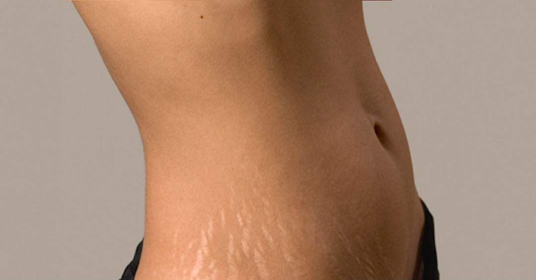 Five Ways To Get Rid Of Stretch Marks Naturally